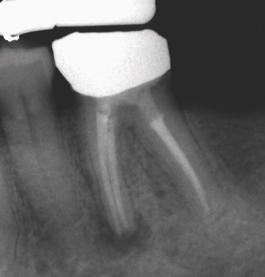 Vertical Root Fracture — Pre-Op