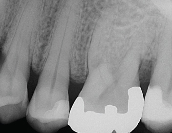 External Resorption — Pre-Op