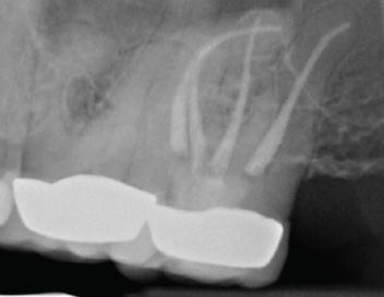 180 Degree MB Root Curvature — Pre-Op