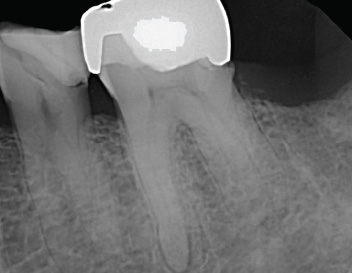 3 Canal Premolar — Pre-Op