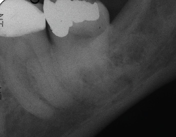 Severe Dilaceration — Pre-Op