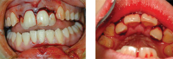 Extrusive Luxation — Pre-Op Clinical