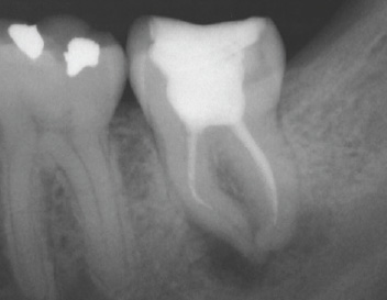 Separated Instrument Removal (Tooth #37) — Pre-Op