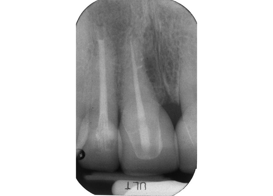Surgical Repair of a Lateral Canal — Pre-Op