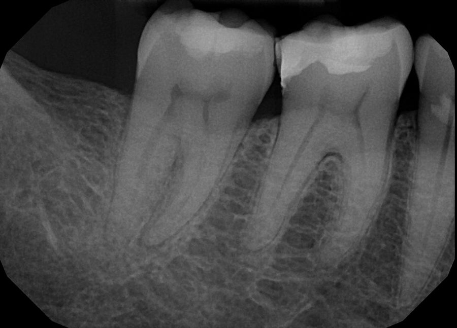 Vertical Fracture — Pre-Op