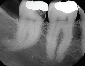 Dilacerated Roots — Pre-Op