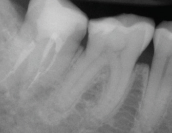 Separated Instrument Removal (Tooth #47) — Pre-Op